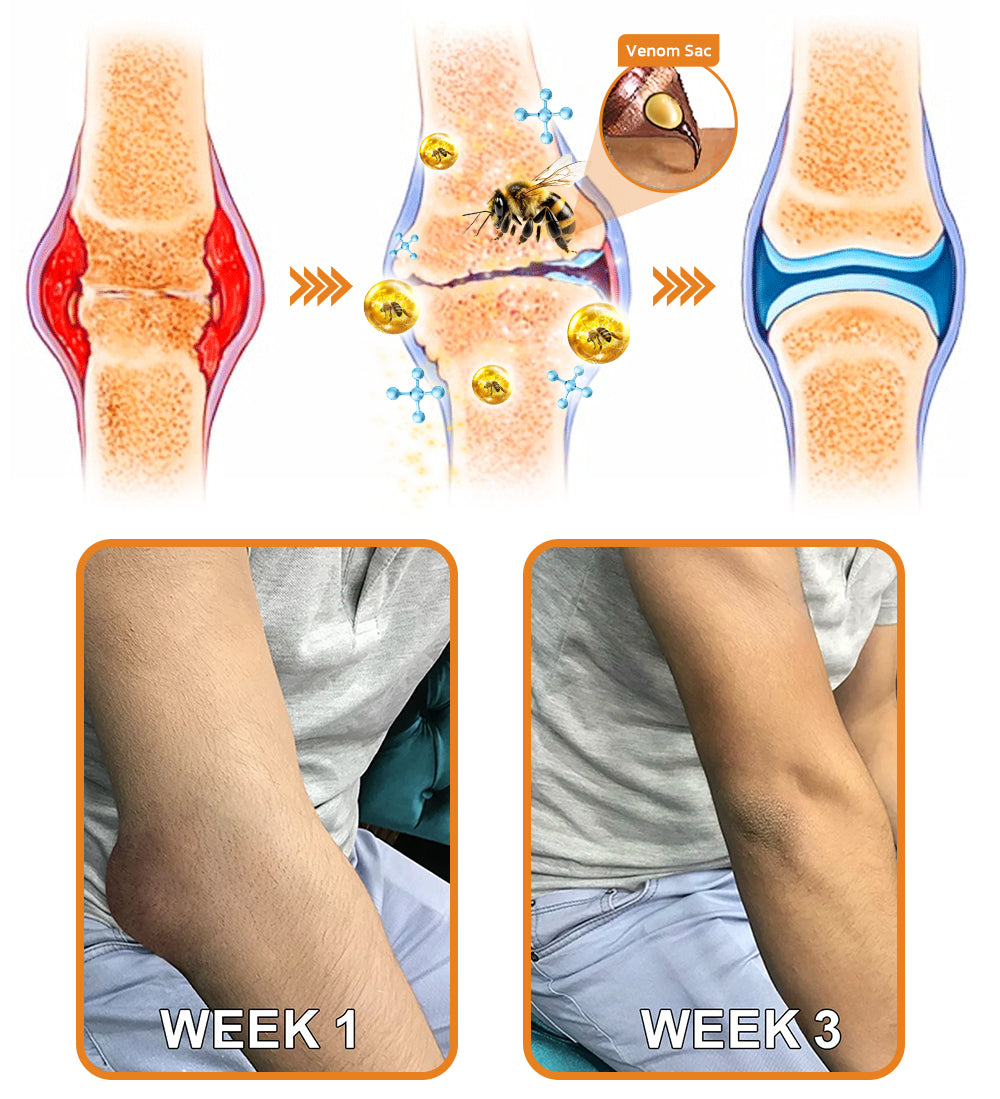 🇺🇸Official Store: flysmus™ Bee-Venom Pain-Relief Bone Healing Cream👨⚕️FDA Certified